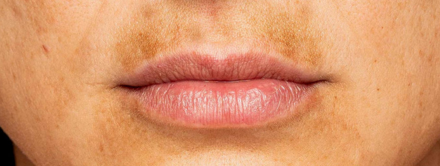 O que realmente funciona no tratamento do melasma?