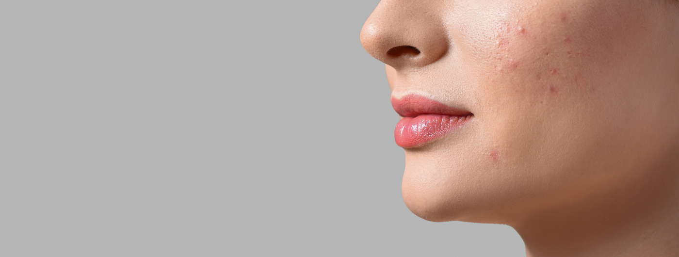 Passo a passo para tratar manchas usando Alfa Arbutin