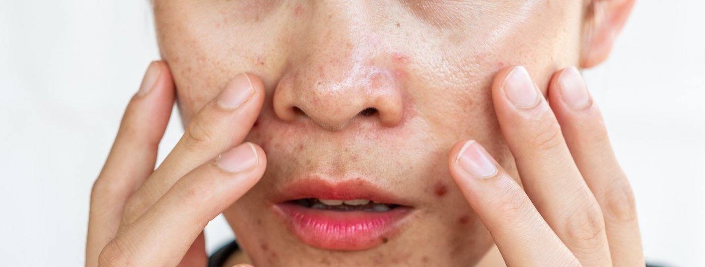 A pele oleosa muda de comportamento no inverno?