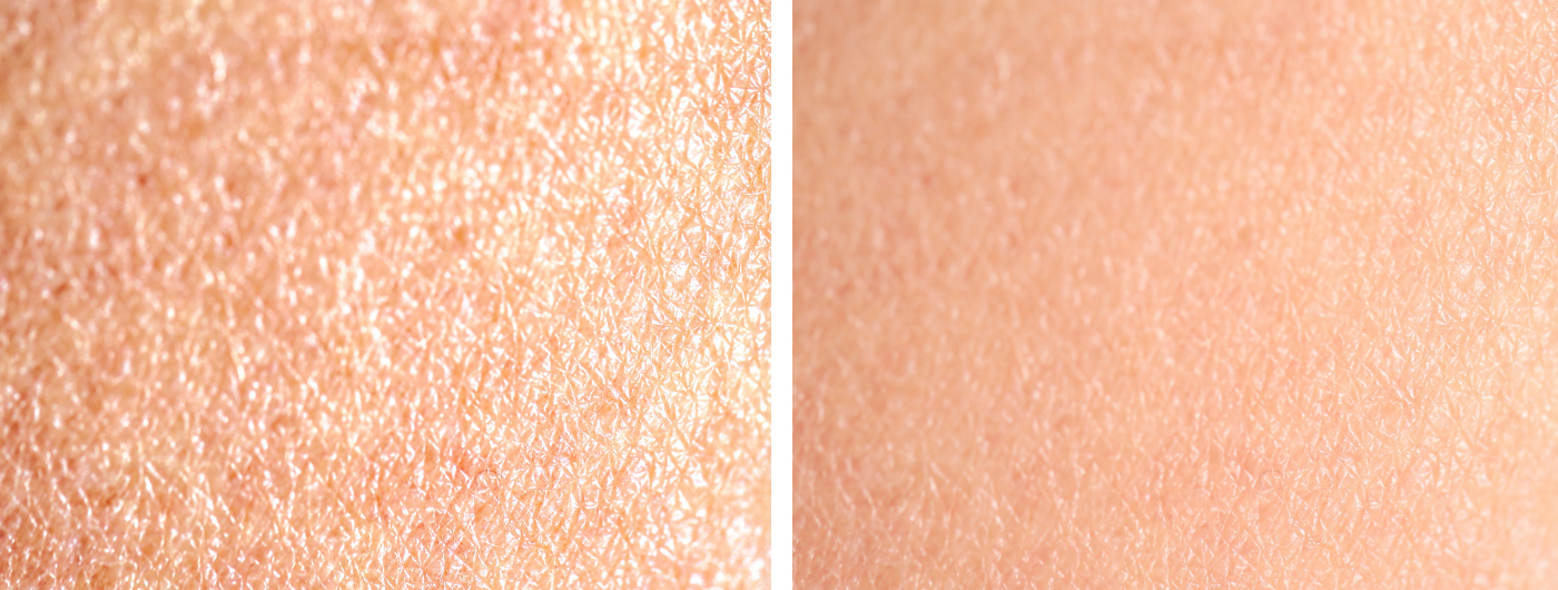 Pele Oleosa vs. Pele Desidratada: quais as diferenças?