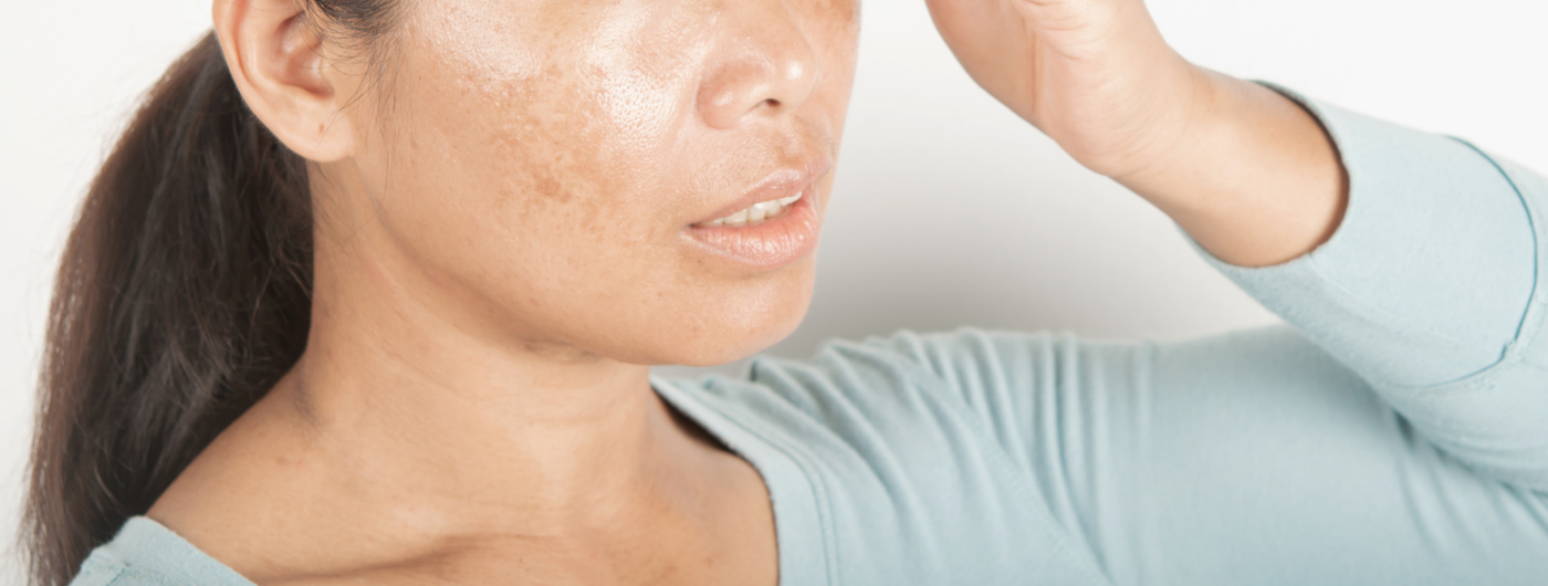 Por que o melasma piora mesmo usando protetor?