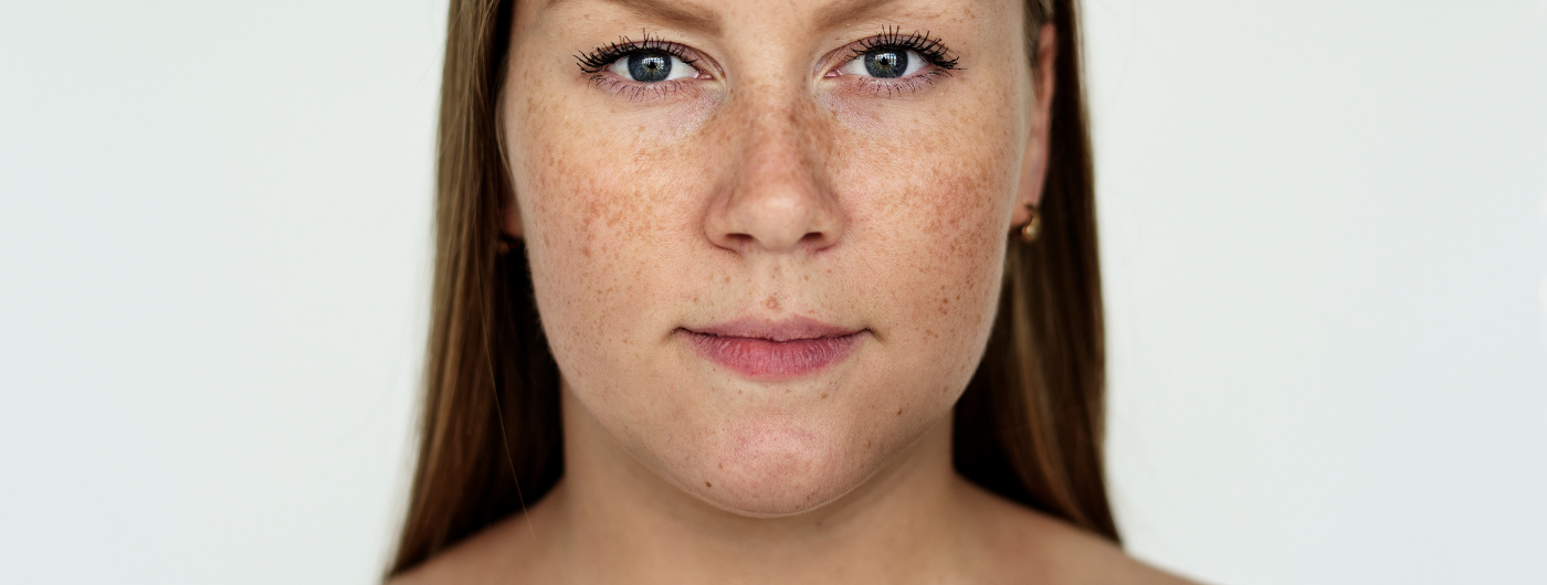 Por que o melasma volta mesmo usando clareadores?