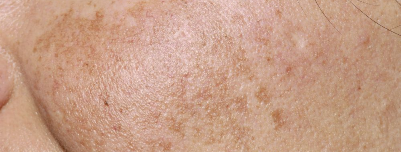 Quais são as principais causas de hiperpigmentação da pele?