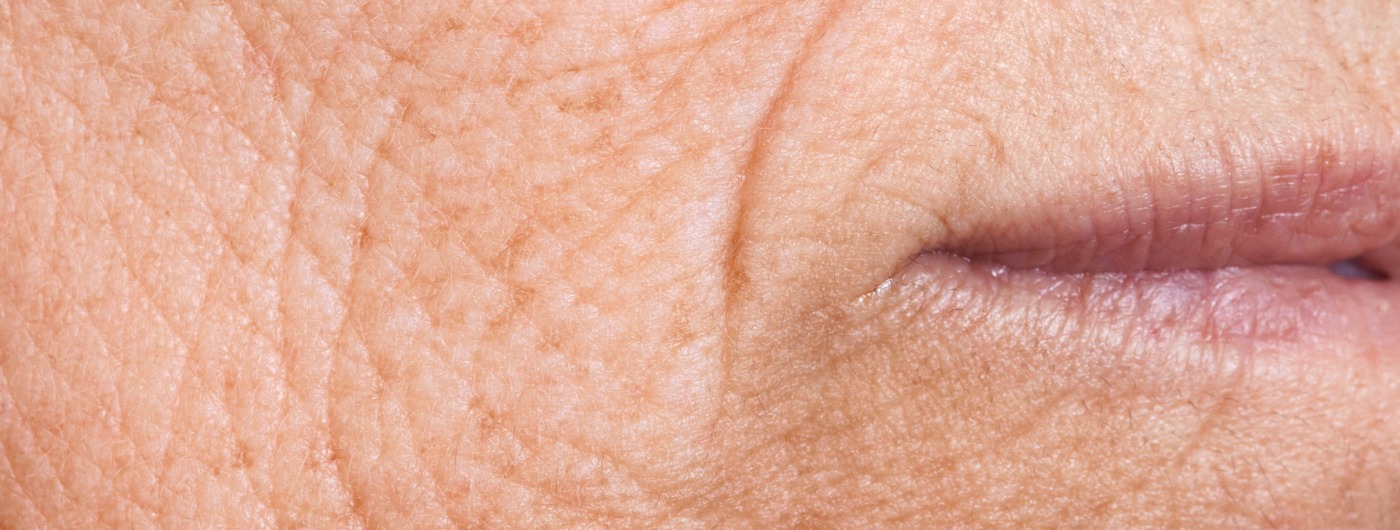 Rugas no rosto: entenda as causas e tratamentos