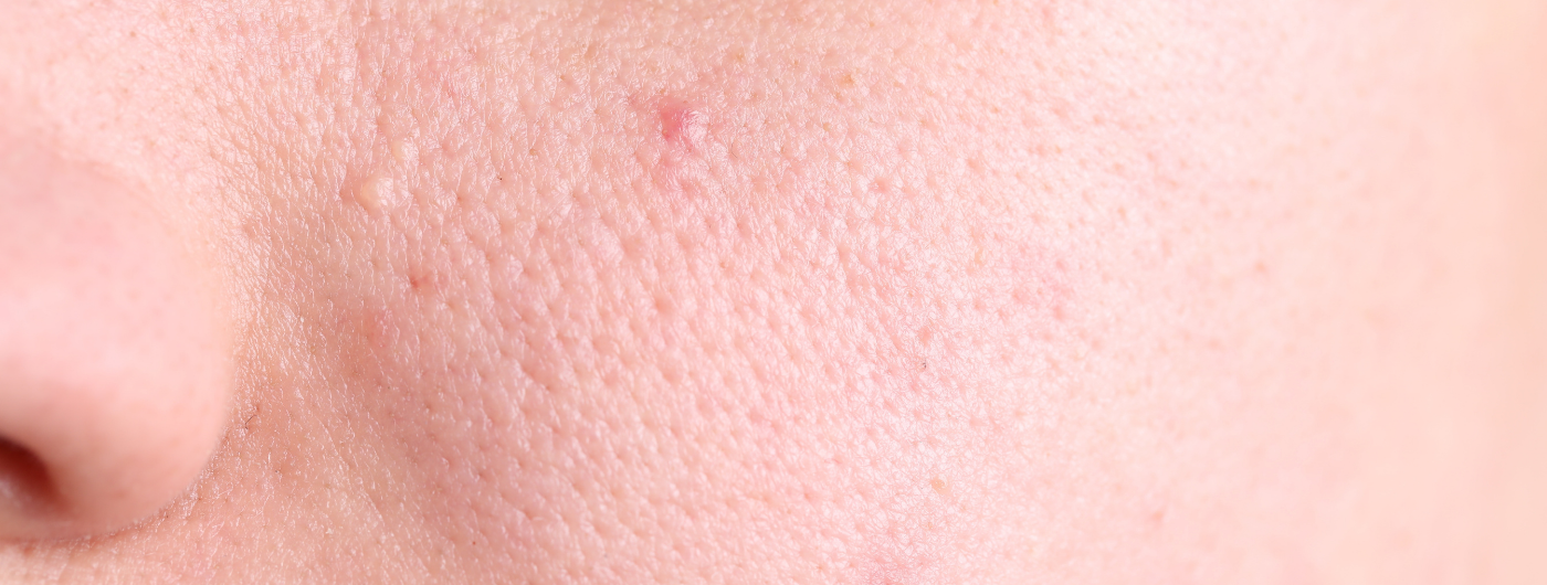 A Vitamina C ajuda a reduzir os poros abertos do rosto?