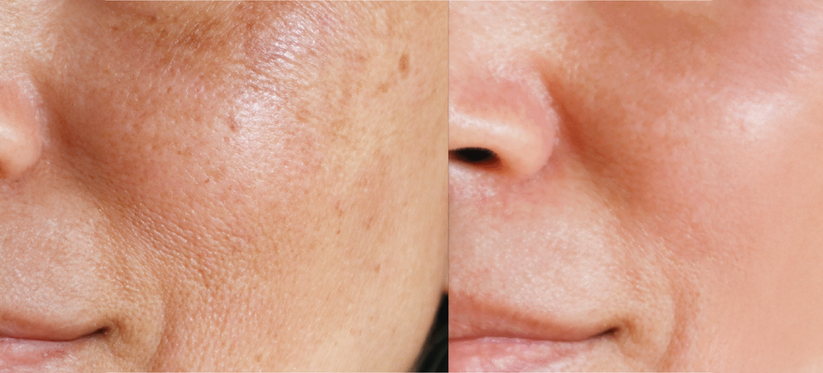Ácido ferúlico ajuda no clareamento e melasma?