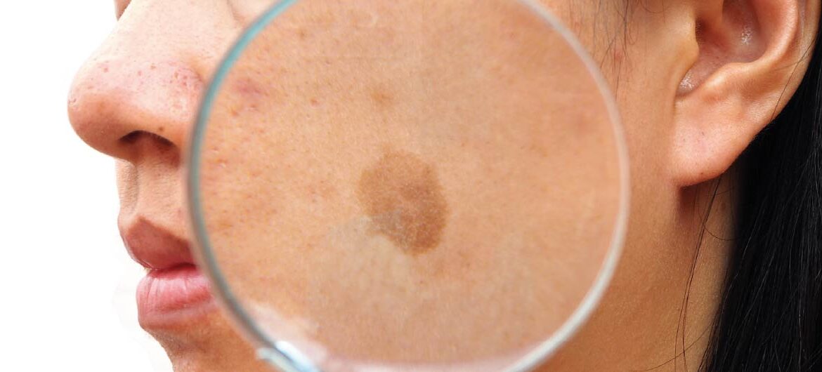 O que piora o melasma? 5 Hábitos que agravam manchas