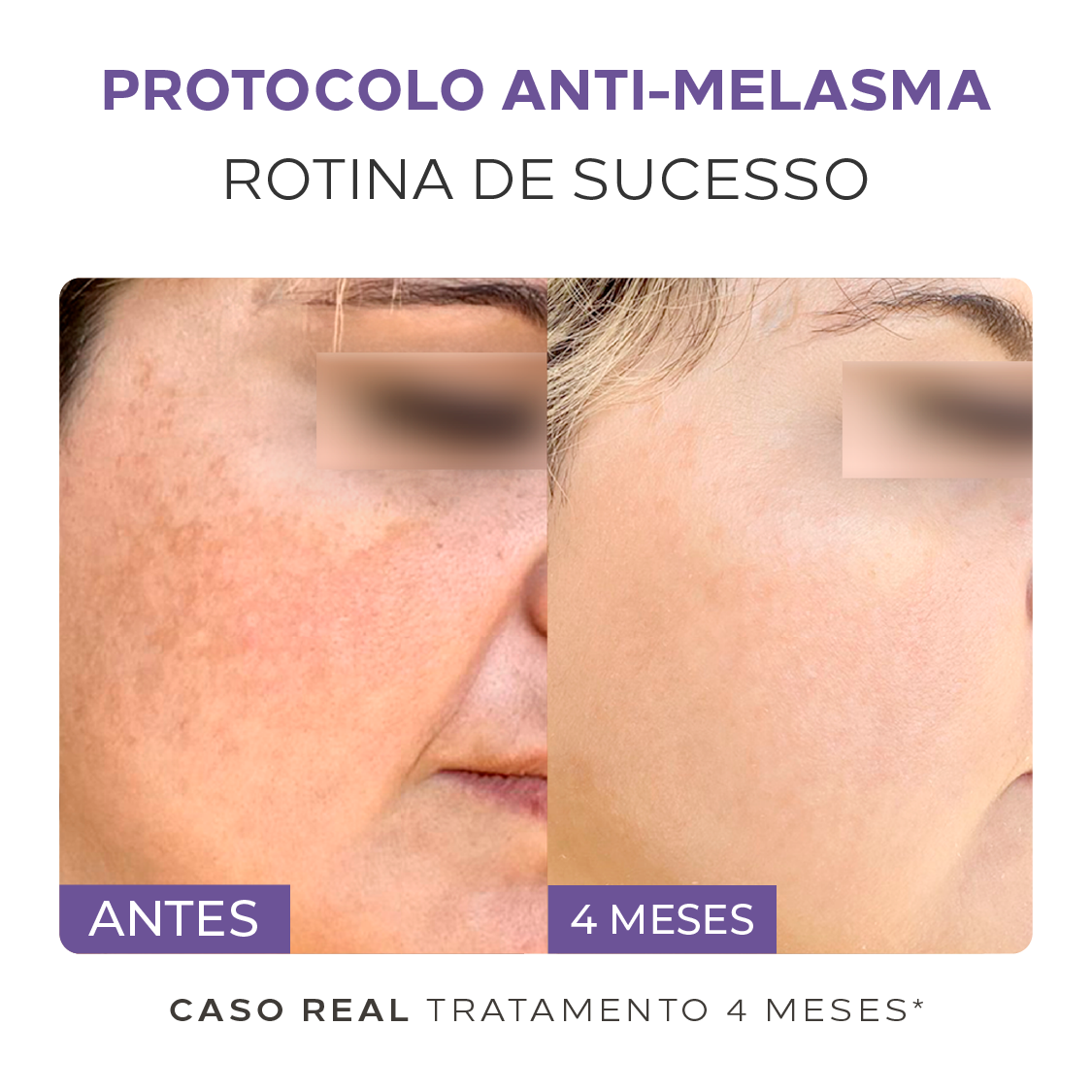 Kit Especial Peles com Manchas e Melasma: Limpeza + Séruns + Fotoproteção 12HS