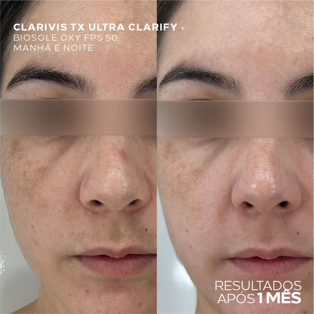 Sérum Clareador Concentrado Para Manchas e Melasma - Clarivis TX Ultra Clarify 30ml