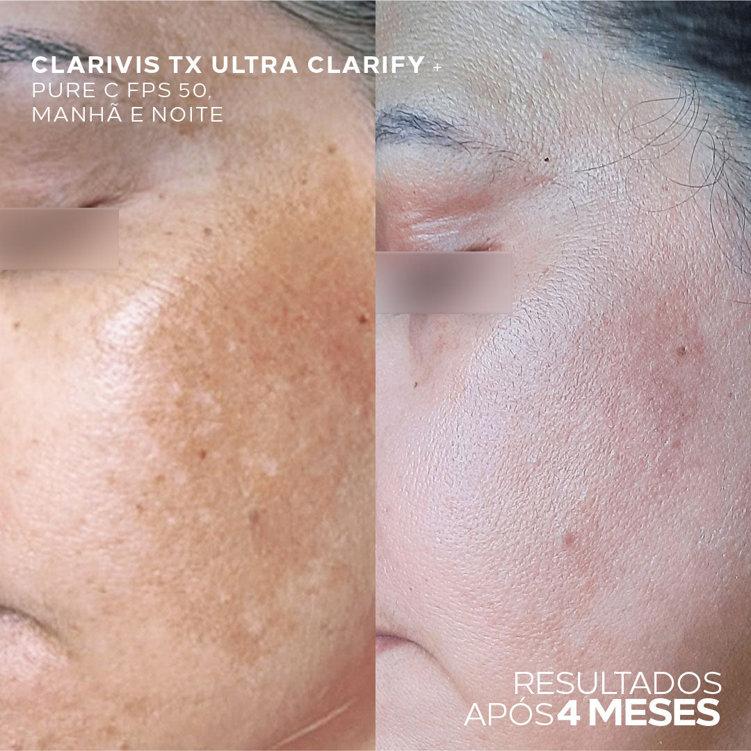Sérum Clareador Concentrado Para Manchas e Melasma - Clarivis TX Ultra Clarify 30ml