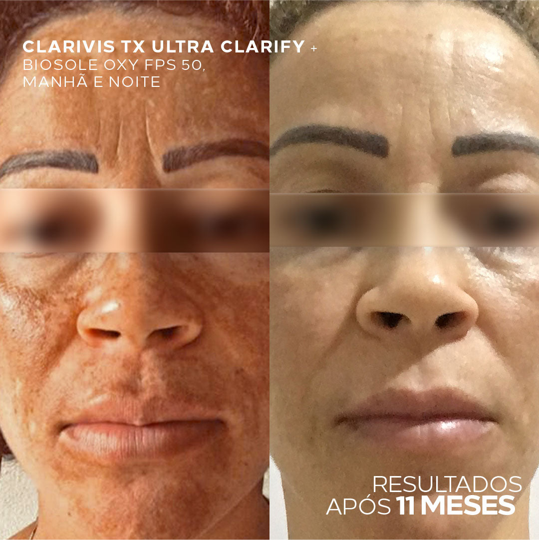 Sérum Clareador Concentrado Para Manchas e Melasma - Clarivis TX Ultra Clarify 30ml