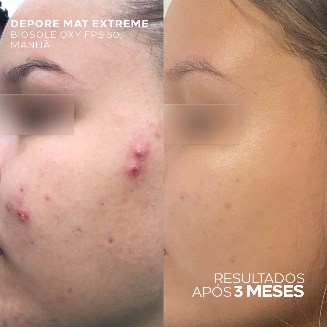 Kit Peles Oleosas Hidratante Matificante + Máscara Facial 3 em 1: Acne, Marcas e Oleosidade