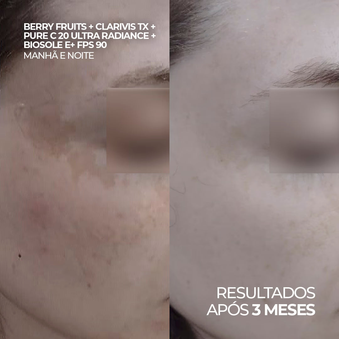 Antes e depois do uso de Berry Fruits, Clarivis TX Ultra Clarify, Pure C 20 Ultra Radiance e Biosole E+ FPS 90, resultados após 3 meses.