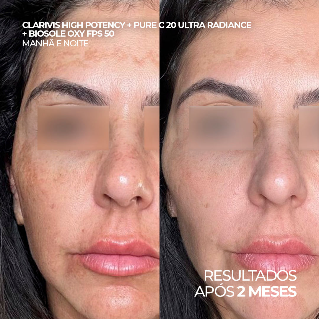 Antes e depois utilizando Clarivis High Potency, Pure C 20 Ultra Radiance e Biosole Oxy FPS 50 por 2 meses.