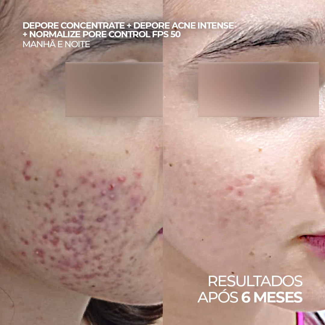 Antes e depois com uso de Depore Concentrate + Depore Acne Intense + Normalize Pore Control FPS 50 por 6 meses.