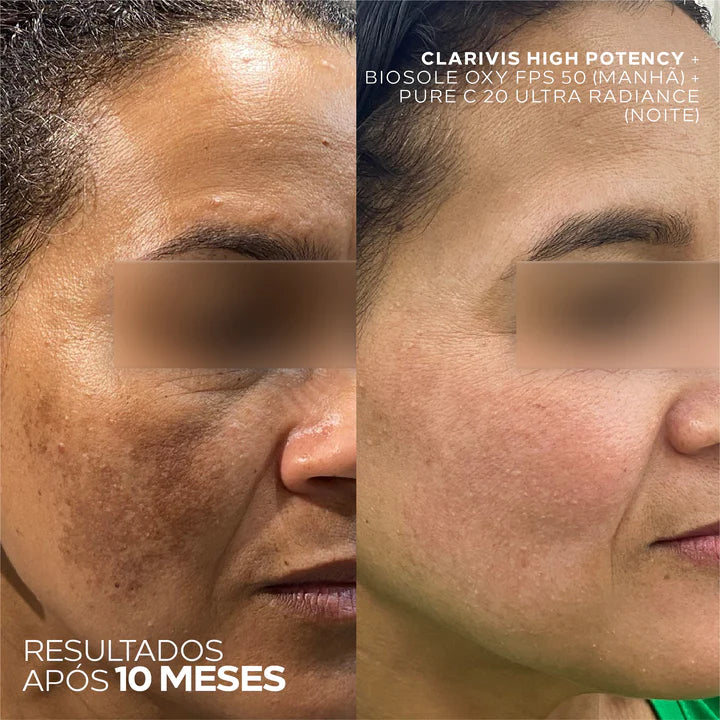 Antes e depois com uso do Clarivis High Potency, Biosole Oxy FPS 50 e Pure C 20 Ultra Radiance, após 10 meses. 
