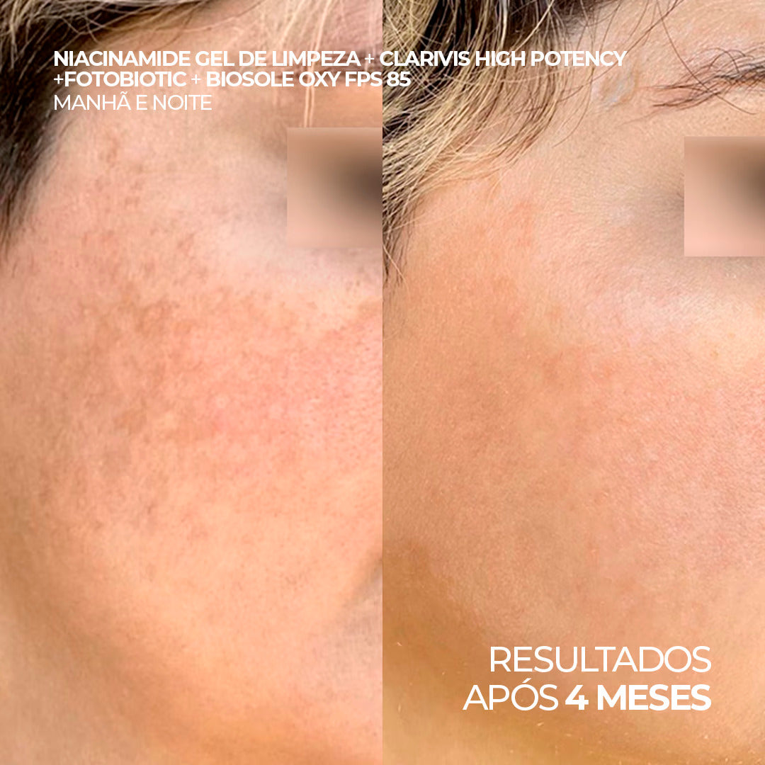 Antes e depois com uso do Niacinamide Gel, Clarivis High Potency, Fotobiotic e Biosole Oxy FPS 85, após 4 meses.