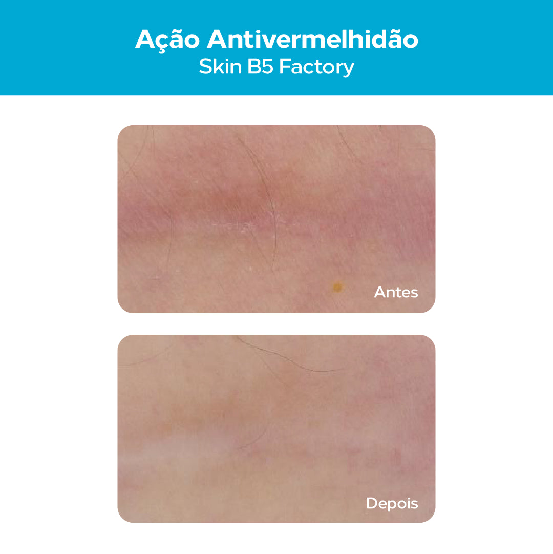 Comparação visual antes e depois da vermelhidão da pele com a ação calmante do CICA B12+ Multirreparador.