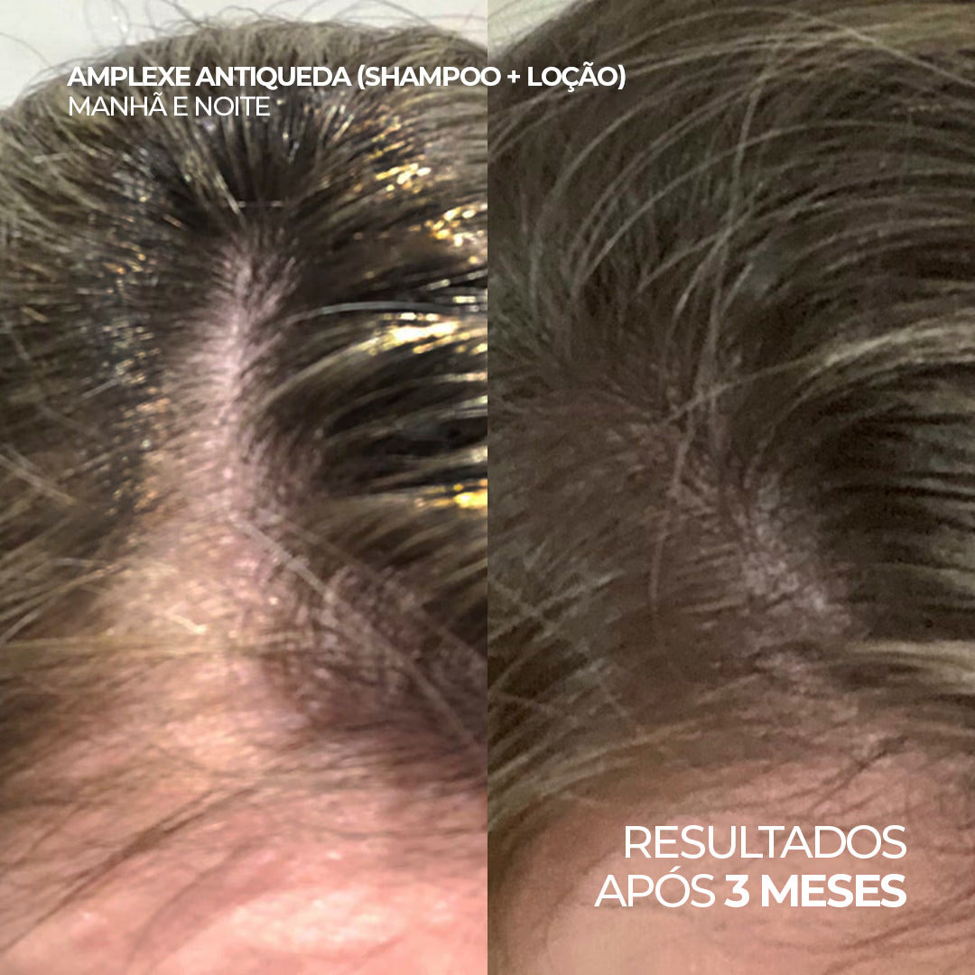Antes e depois com o uso do shampoo e loção Amplexe Antiqueda, resultados após 3 meses.