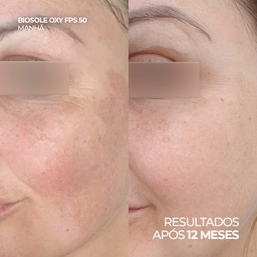 Antes e depois do uso de Biosole Oxy FPS 50, resultados após 10 meses.