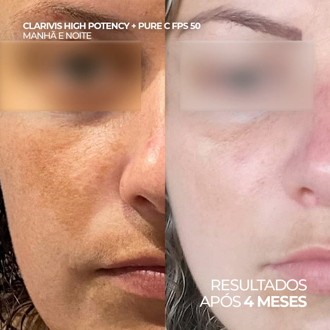 Antes e depois com uso do Clarivis High Potency e Pure C FPS 50, após 4 meses. 