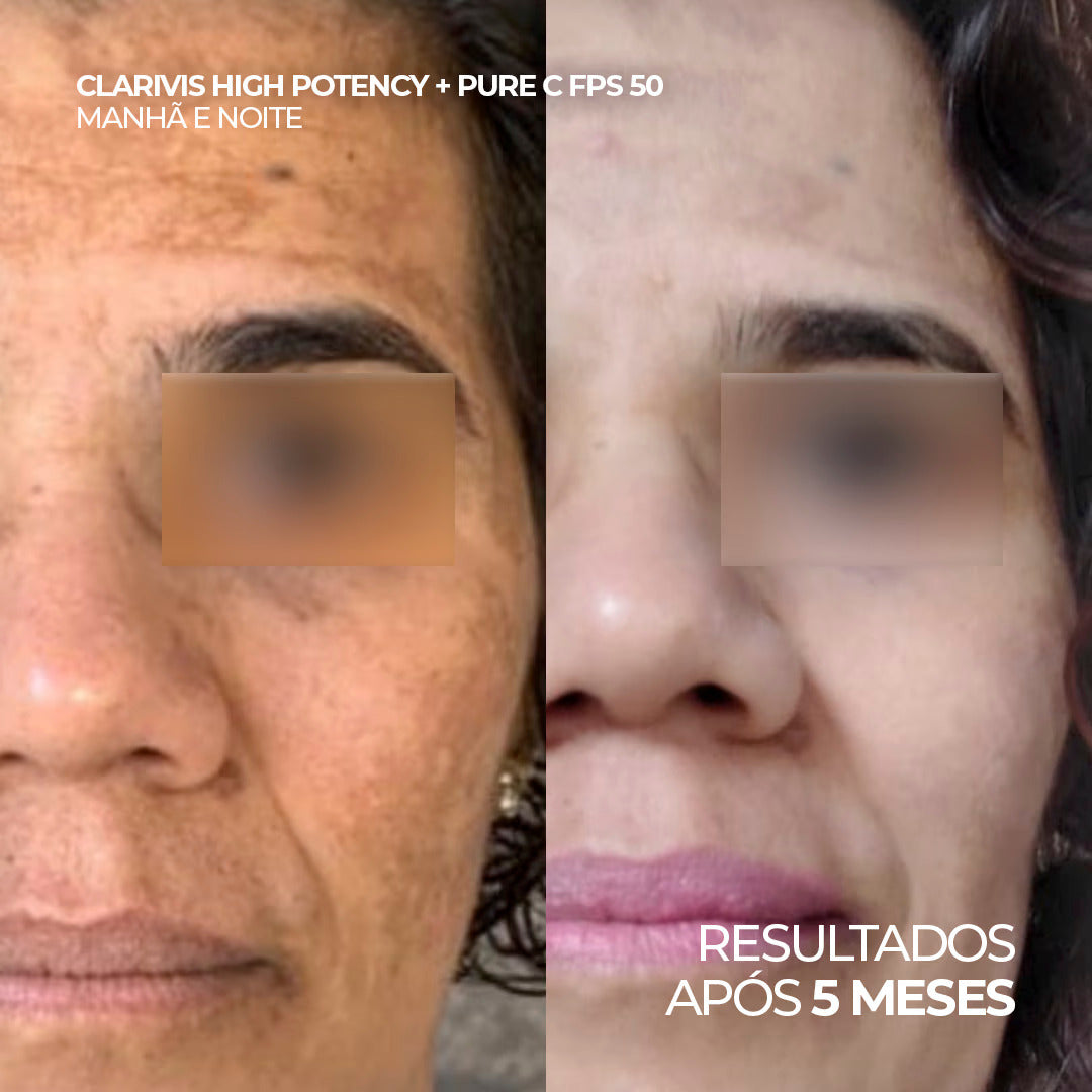 Antes e depois com uso do Clarivis High Potency e Pure C FPS 50, após 5 meses. 