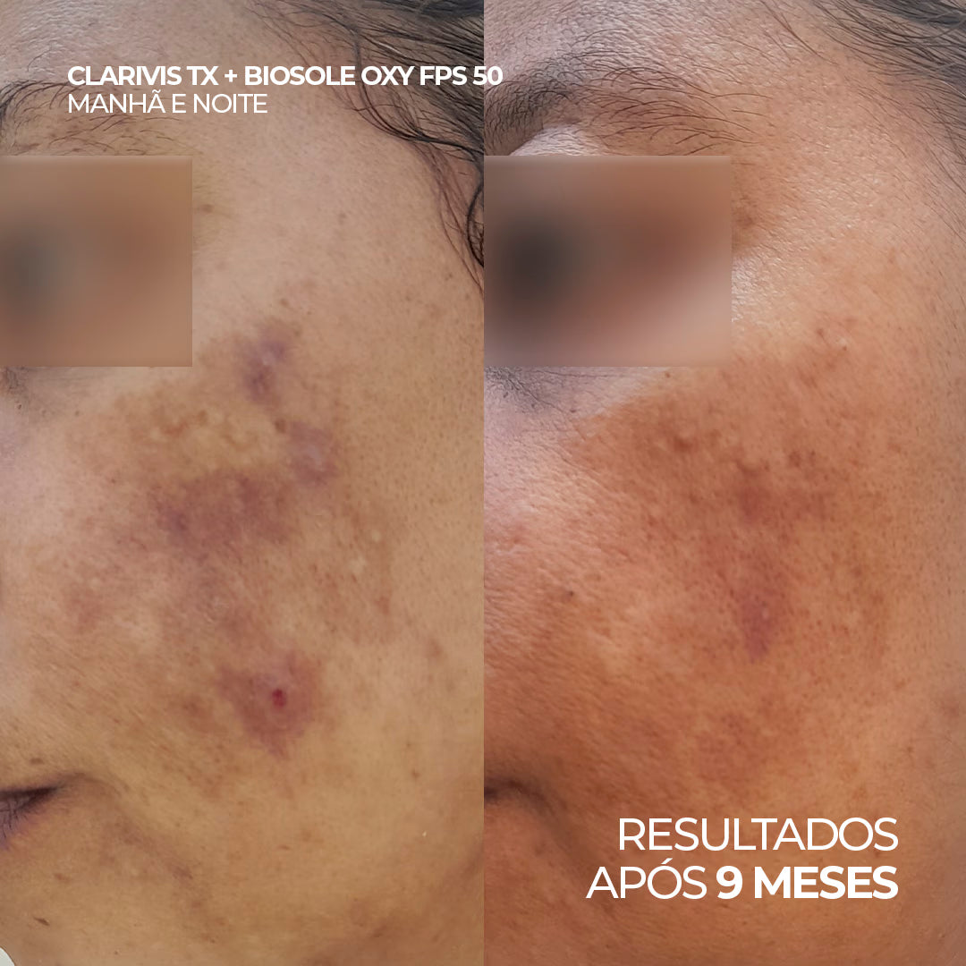 Antes e depois do uso de Clarivis TX Ultra Clarify e Biosole Oxy FPS 50, resultados após 9 meses de aplicação.