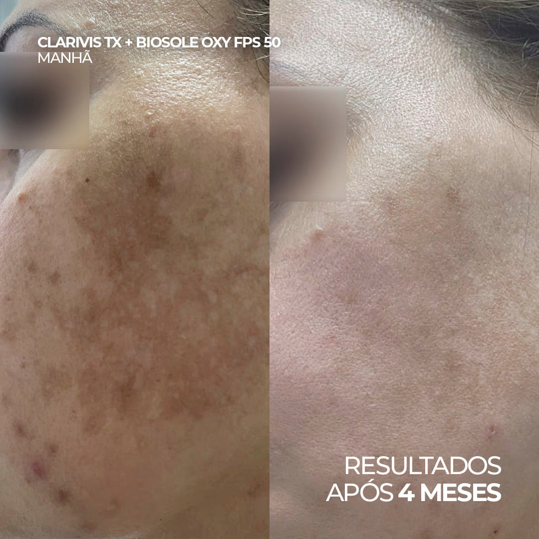 Sérum Clareador de Melasma e Manchas com Tranexâmico – ADA TINA