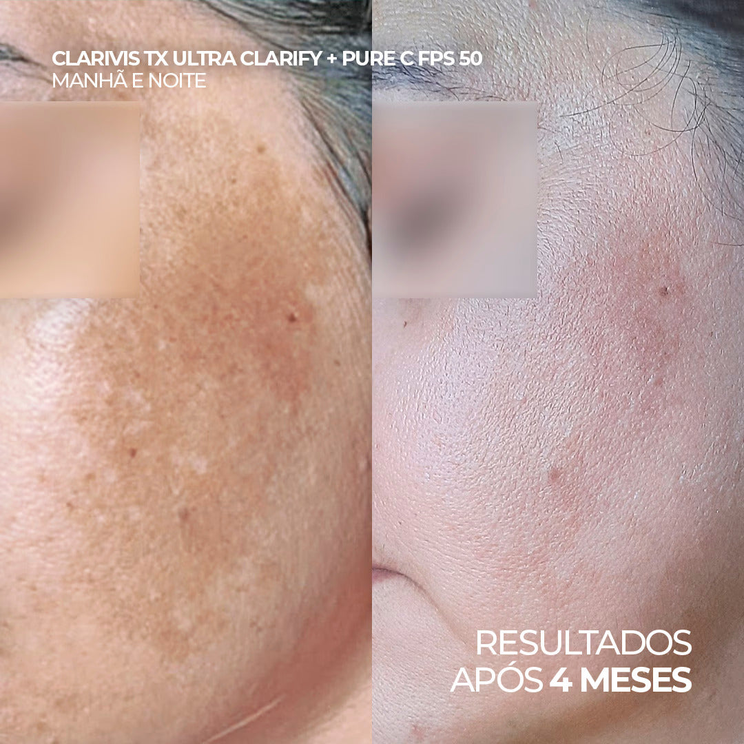 Antes e depois com uso do Clarivis TX e Pure C FPS 50, após 4 meses. 