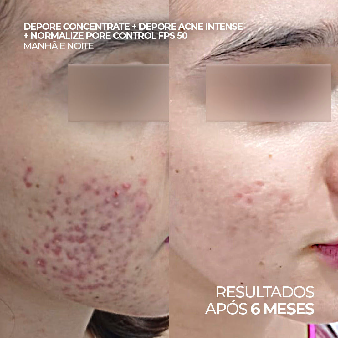 Antes e depois utilizando o gel de limpeza Depore Concentrate, o sérum Depore Acne Intense e protetor solar Normalize Pore Control FPS 50 por 6 meses.