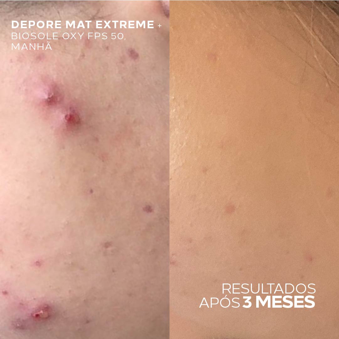 Antes e depois Depore Mat Extreme Ada Tina resultados após 3 meses.