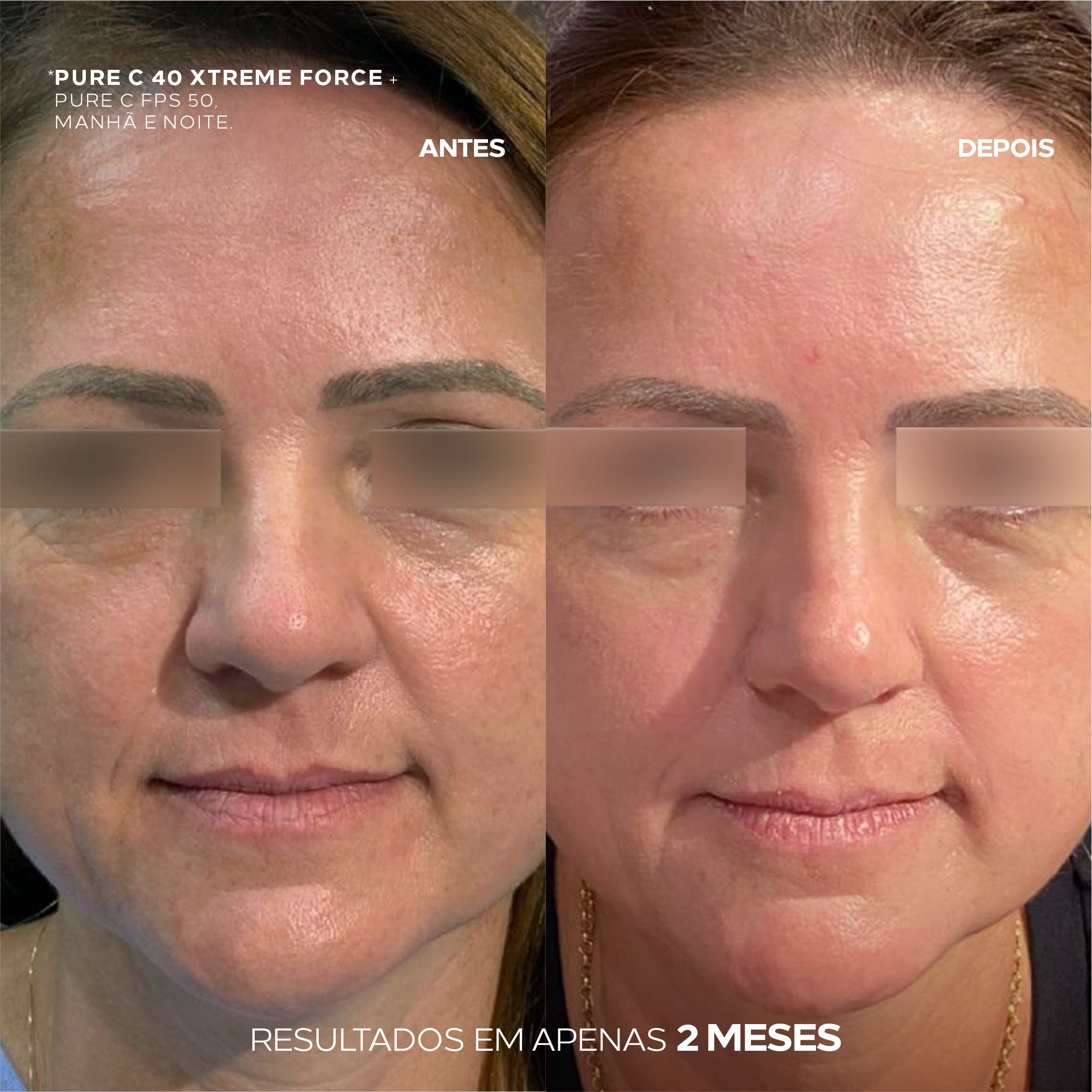 Antes e depois do uso de Ada Tina Pure C 40 Xtreme Force clareador facial.