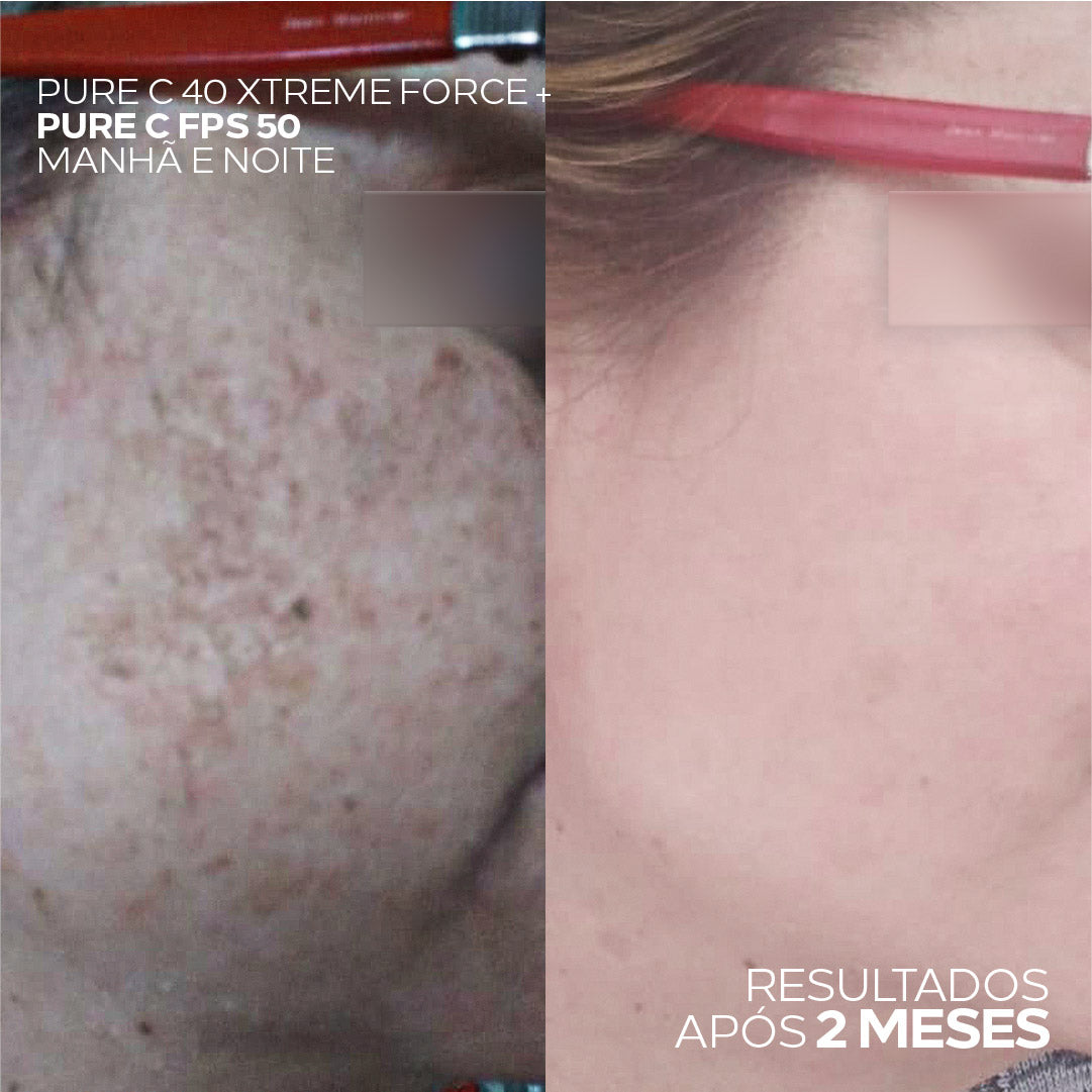 Resultados antes e depois com Ada Tina Pure C FPS 50 clareador.