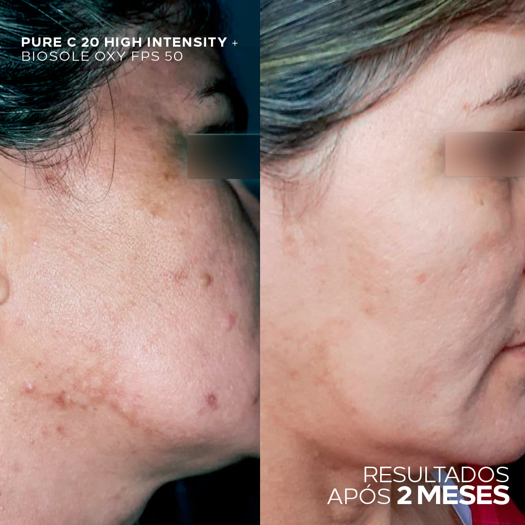 Antes e depois com uso de Pure C 20 High Intensity, resultado após 2 meses.