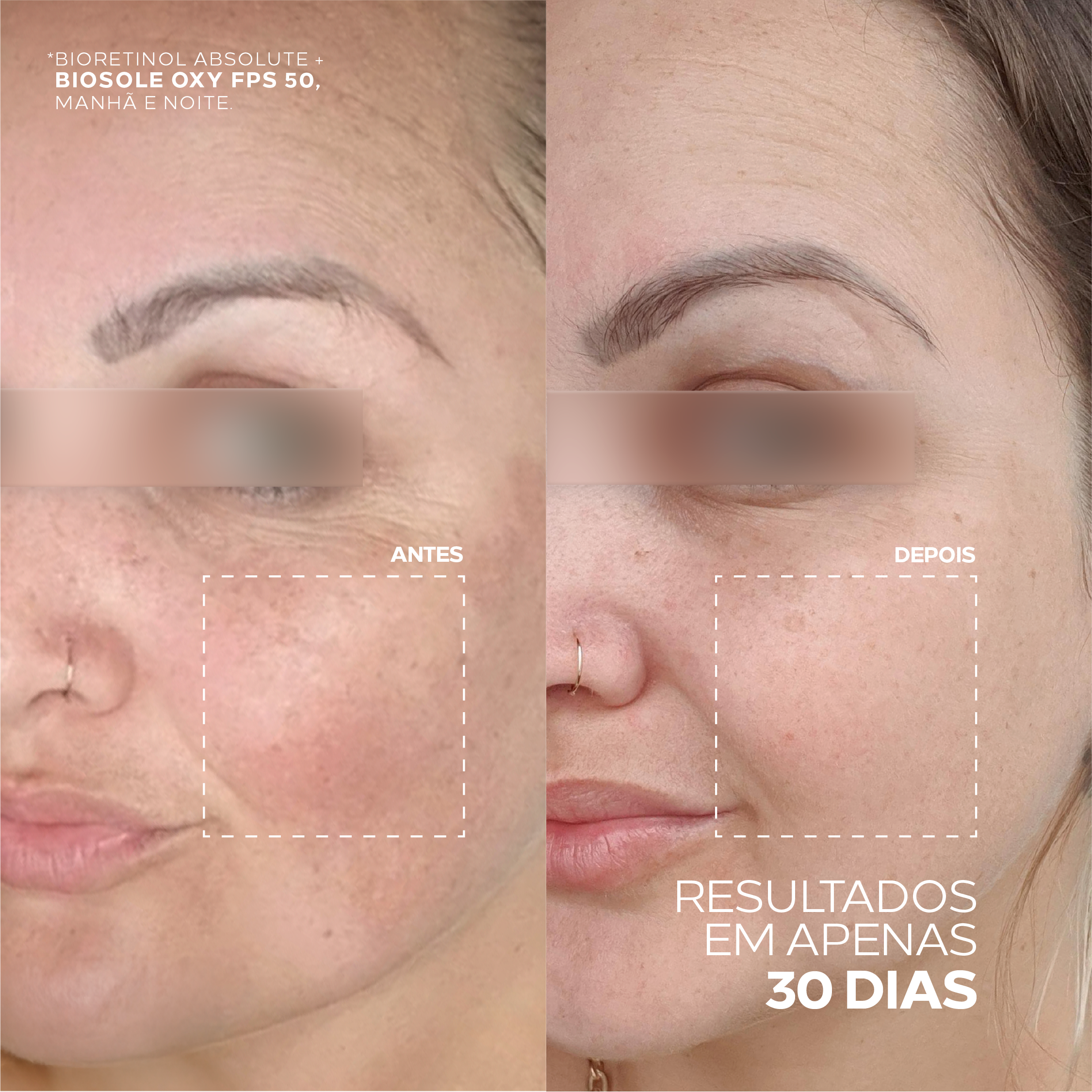 Antes e depois utilizando o protetor solar Biosole Oxy FPS 85 por 30 dias.