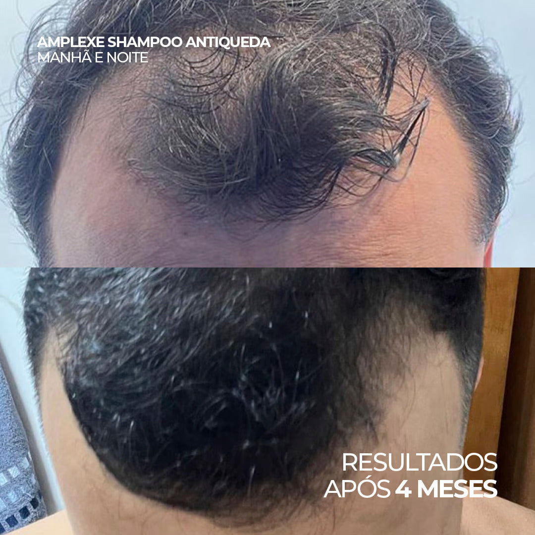 Antes e depois com o uso do shampoo Amplexe Antiqueda, resultados após 4 meses.