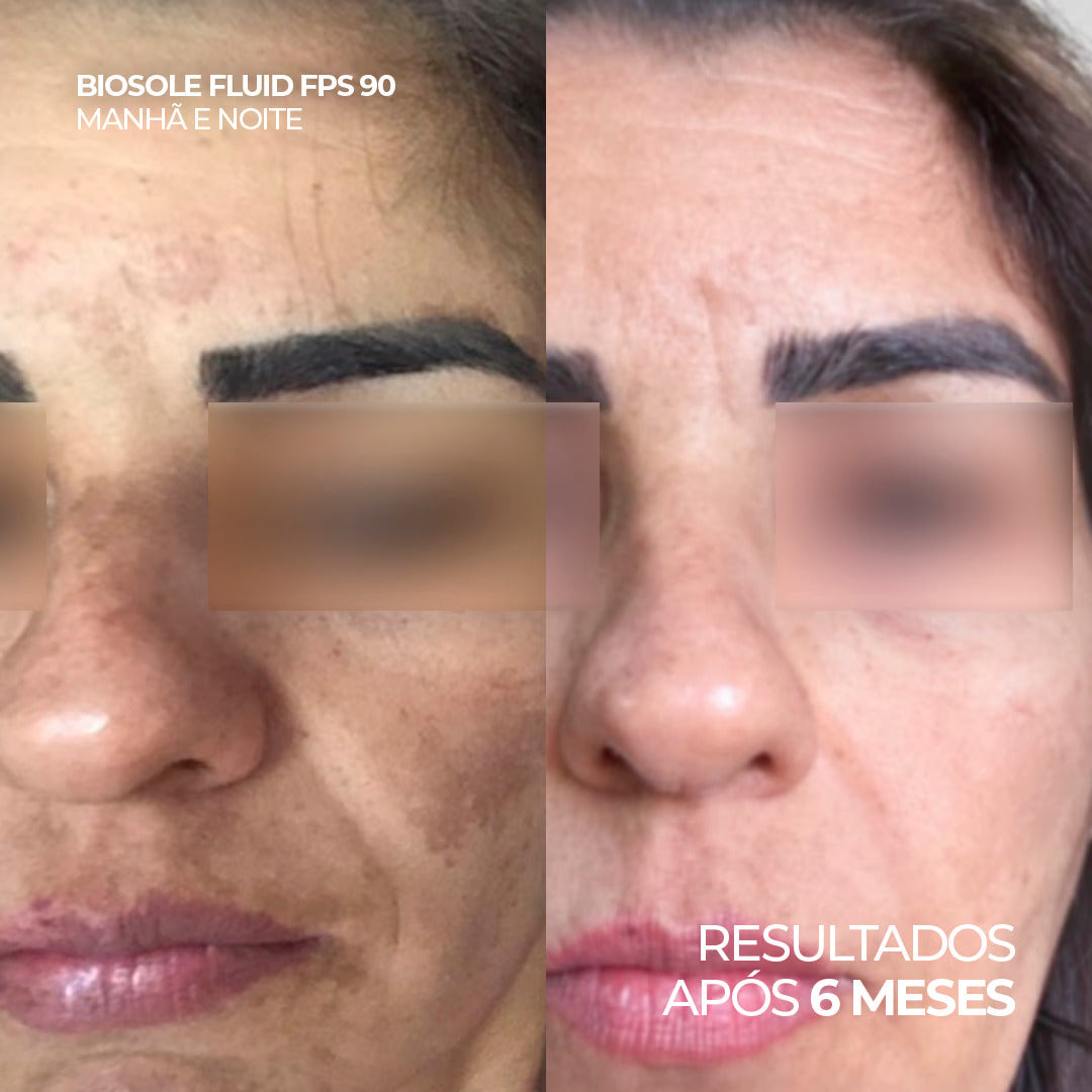 Antes e depois do uso de Biosole Fluid FPS 90, resultados após 6 meses.