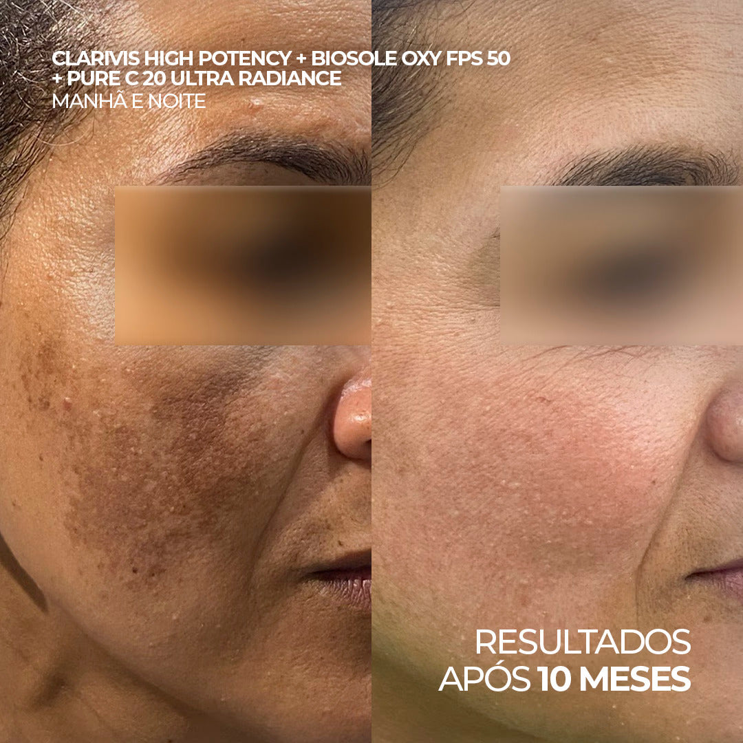 Antes e depois do uso de Clarivis High Potency, Pure C 20 e Biosole Oxy FPS 50, resultados após 11 meses.
