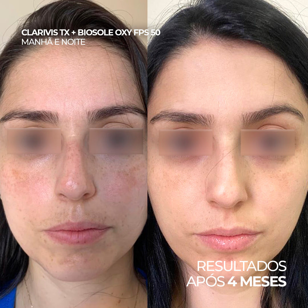Antes e depois utilizando o sérum Clarivis TX e protetor solar Biosole Oxy FPS 50 por 4 meses.