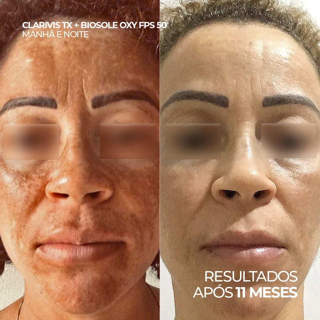 Antes e depois do uso de Clarivis TX Ultra Clarify e Biosole Oxy FPS 50, resultados após 11 meses.