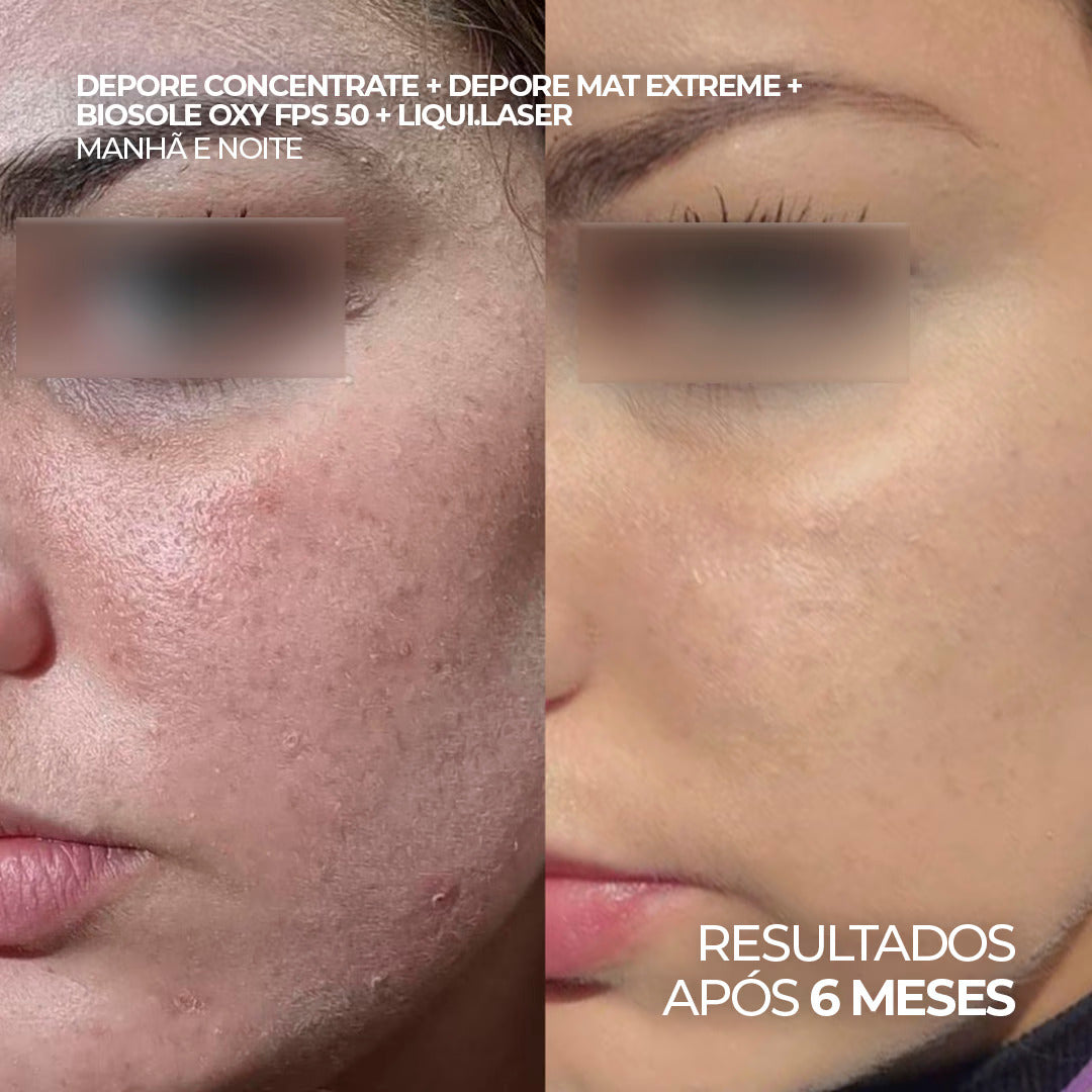 Antes e depois utilizando o sérum Liqui.Laser e protetor solar Biosole Oxy FPS 50 por 6 meses.