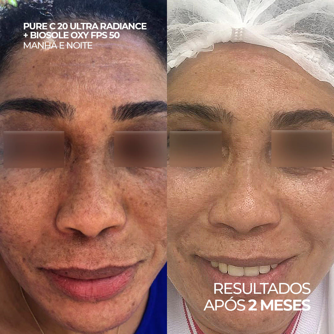 Antes e depois utilizando o creme Pure C 20 Ultra Radiance e protetor solar Biosole Oxy FPS 50 por 2 meses.