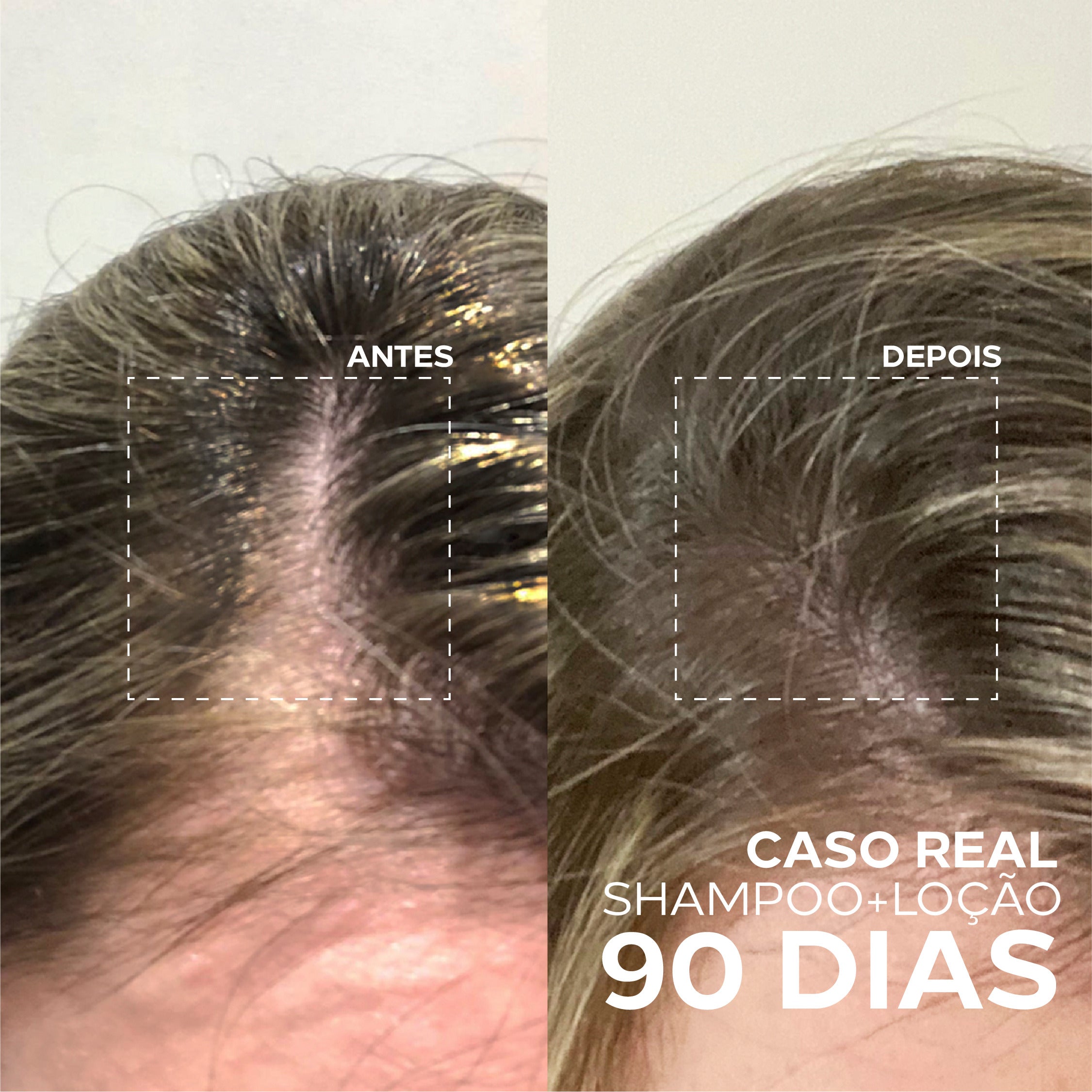 Antes e depois do tratamento com Amplexe Antiqueda Ada Tina mostrando redução da queda e maior densidade capilar.