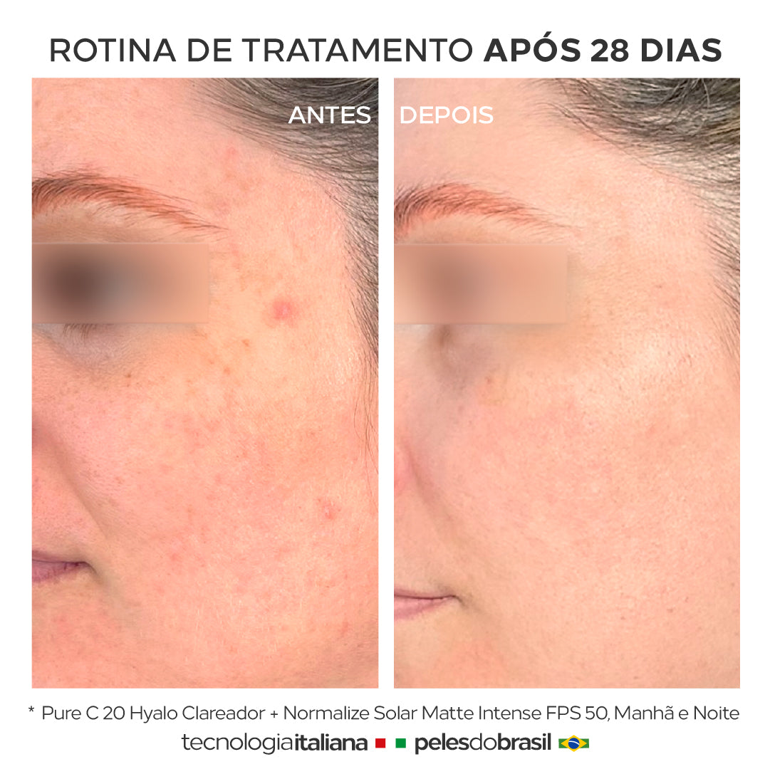 Antes e depois do uso de Normalize Solar Matte Intense FPS 50, resultados visíveis em apenas 28 dias. 