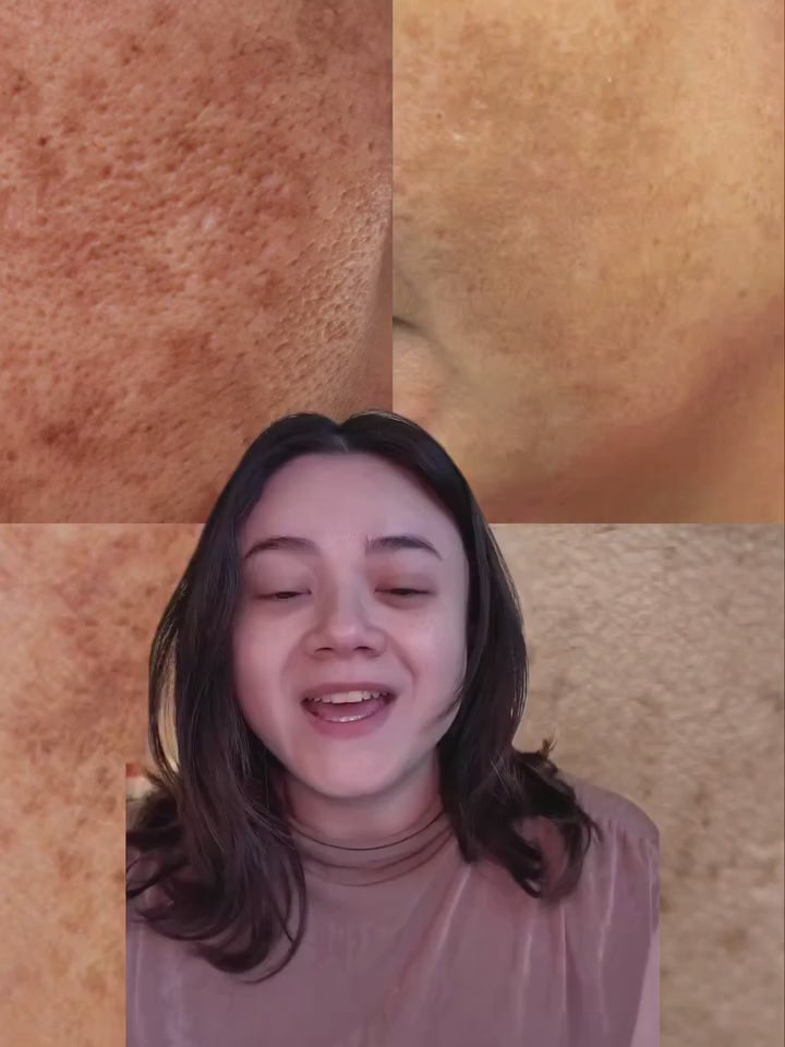 Kit Completo Clareador para Pele com Melasma e Manchas Resistentes