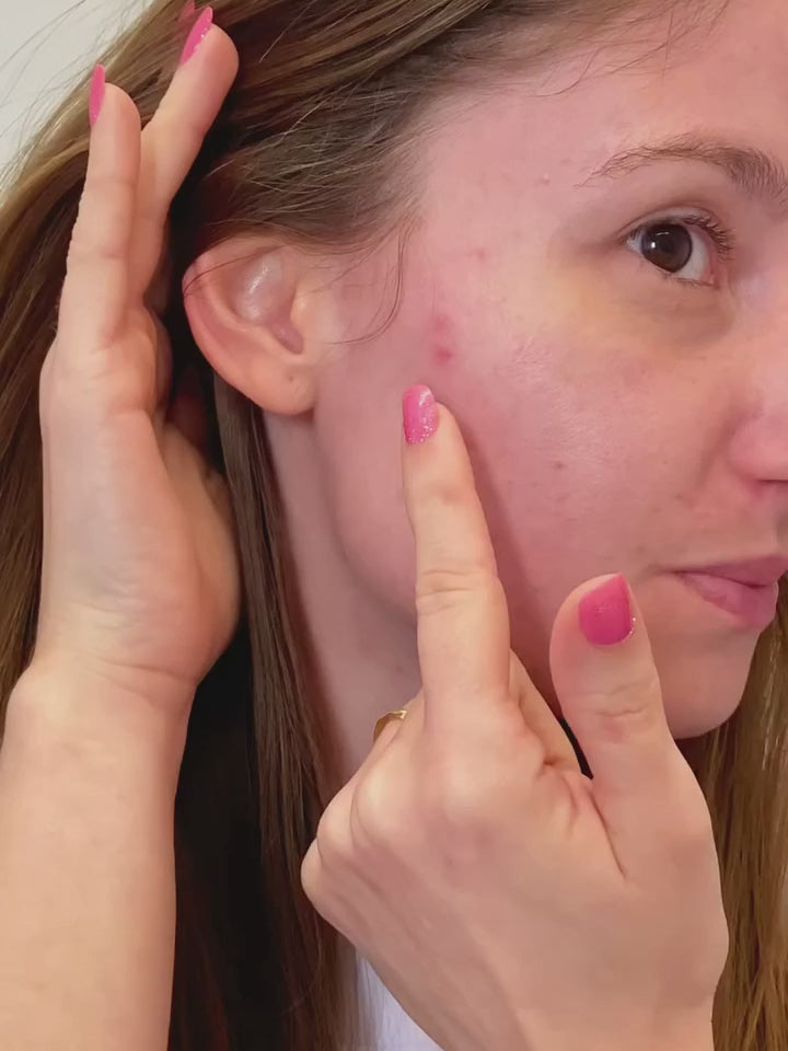 Sérum Intensivo para Pele com Acne, Oleosidade e Marcas – Depore Acne Intense