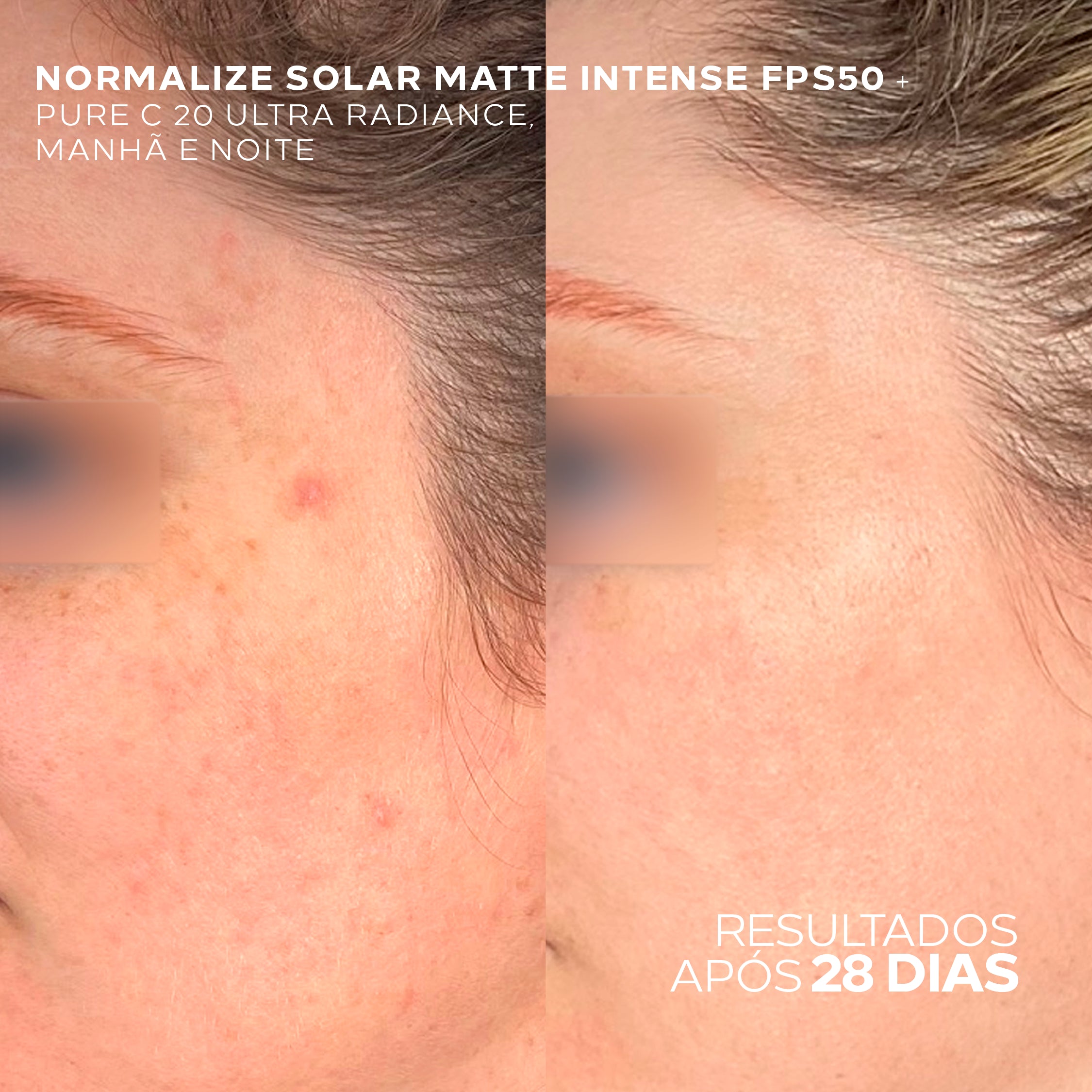 Antes e depois com Normalize Solar Matte Intense após 28 dias de uso.