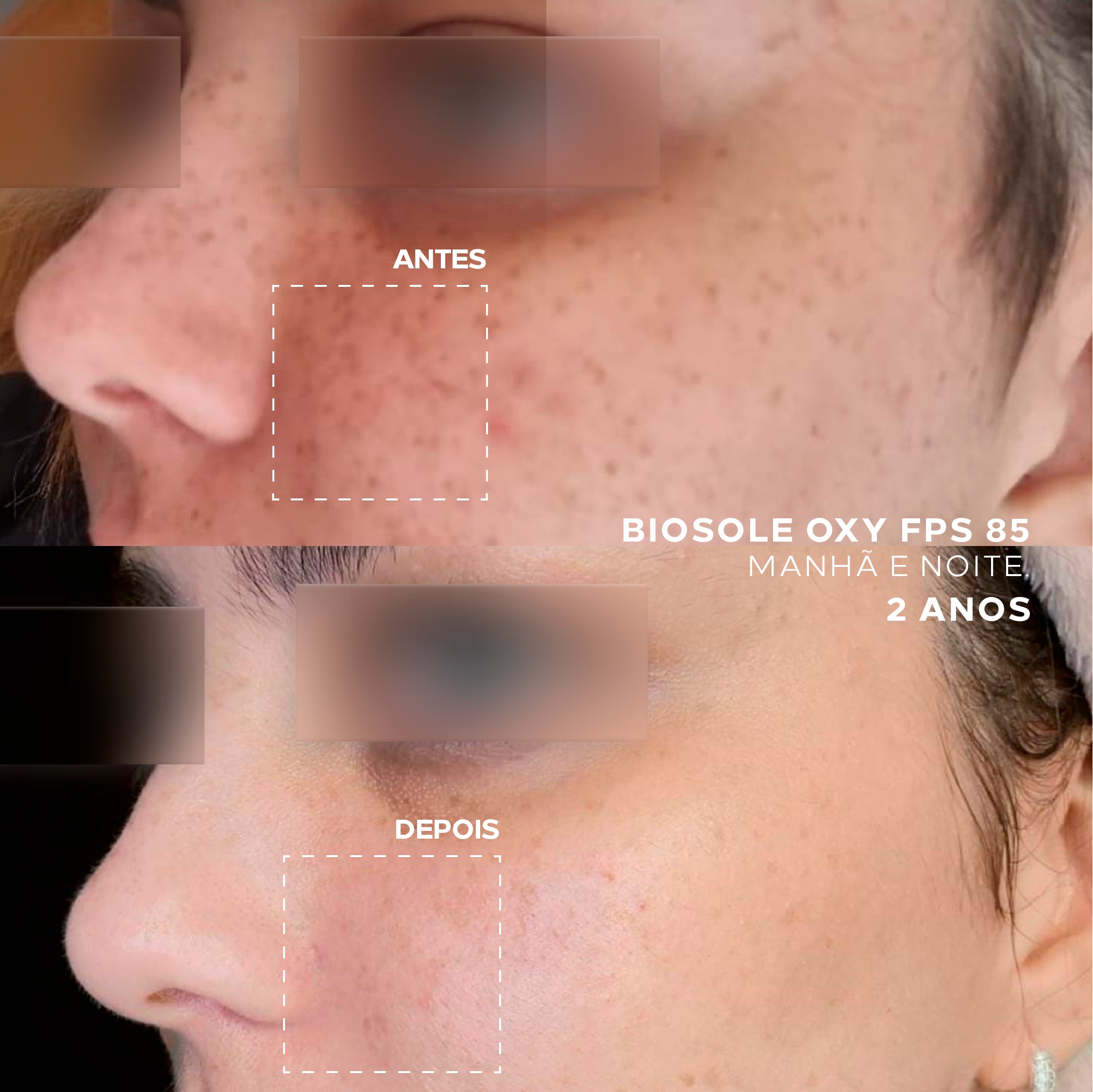 Antes e depois: Biosole Oxy FPS 85 por 2 anos.