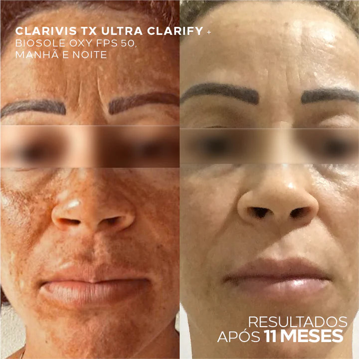Kit de Cuidados Cosméticos para Pele com Melasma Avançado